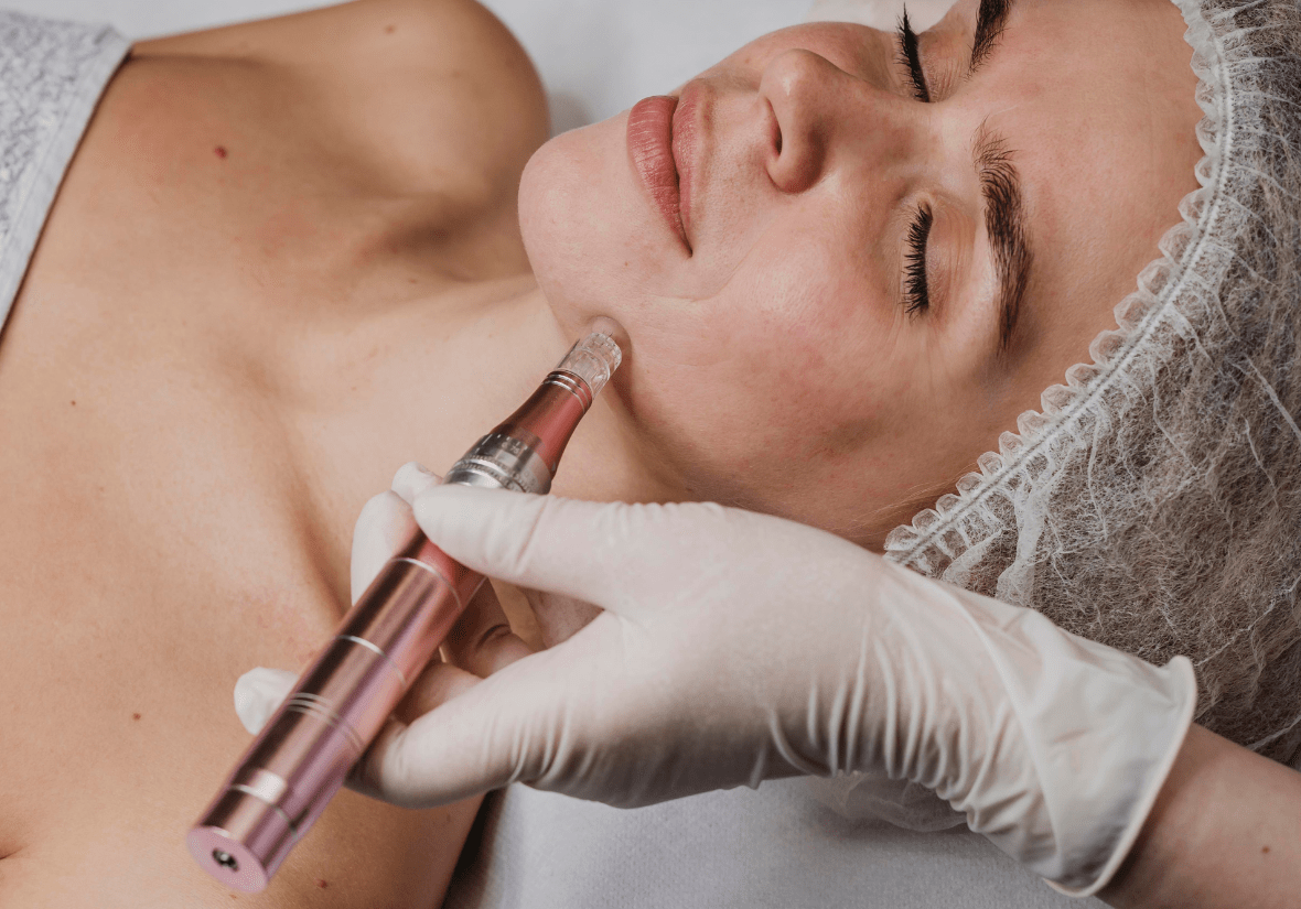 Microneedling treatment 123